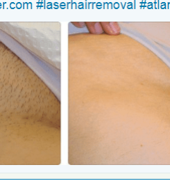 Atlanta Laser Hair Removal