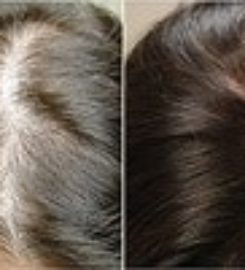 Sani PRP Hair MD