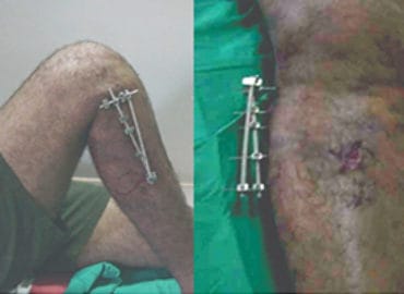 Best Ortho Specialist Hospital in Coimbatore | Orthopedic Treatme &hellip;