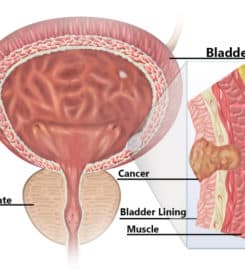 Best Urologist In North Delhi | Dr. Anish Gupta