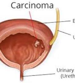 Best Urologist In North Delhi | Dr. Anish Gupta