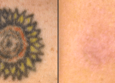 Tattoos Be Gone Las Vegas