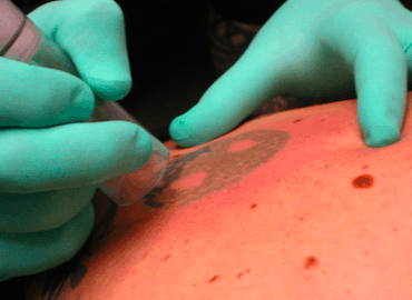 Tattoos Be Gone Las Vegas