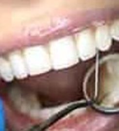 Tooth Filling