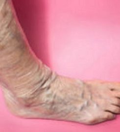 Varicose Vein Treatments Center