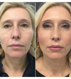 Botox Injection