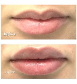 Best Acne Treatment