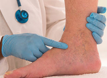 Leg Vein Doctors