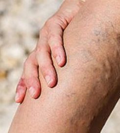 Varicose Vein Treatments Center