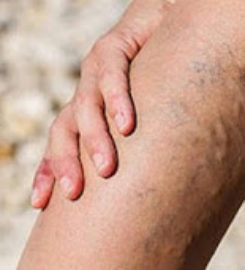 Vein Doctors of New York