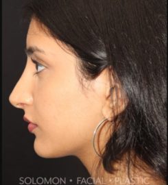 Dr. Philip Solomon MD | Rhinoplasty Toronto