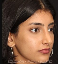 Dr. Philip Solomon MD | Rhinoplasty Toronto