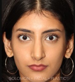Dr. Philip Solomon MD | Rhinoplasty Toronto