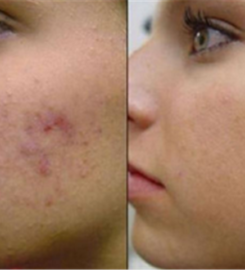 Chemical Peel