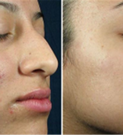 Chemical Peel