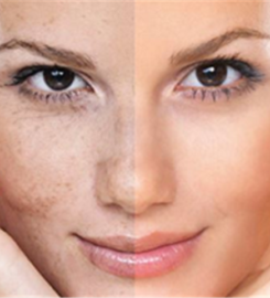 Chemical Peel