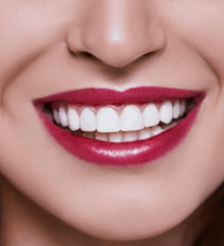 Porcelain Veneers Brooklyn
