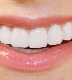 Porcelain Veneers Brooklyn