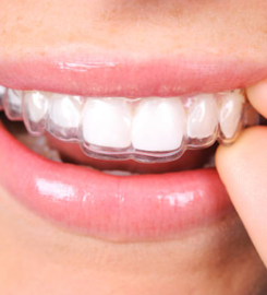 Porcelain Veneers NYC