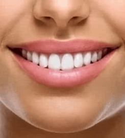 Porcelain Veneers Brooklyn