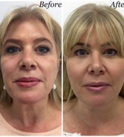 Face & Dermal Fillers