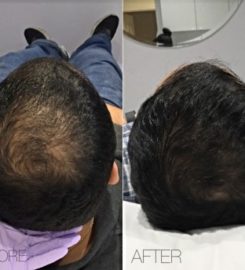 Chemical Peel
