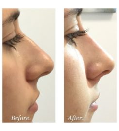 Face & Dermal Fillers