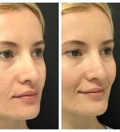 Chemical Peel
