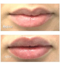 Whiteheads & Blackheads Removal