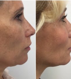 Face & Dermal Fillers