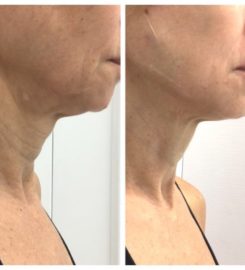 Face & Dermal Fillers