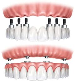 Porcelain Veneers NYC
