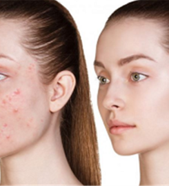 Chemical Peel