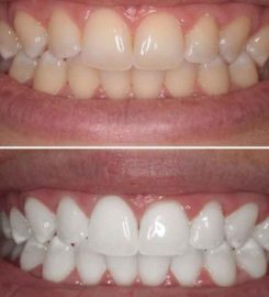 Tooth Extraction Center Brooklyn