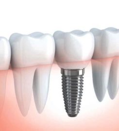 Tooth Extraction Center Brooklyn