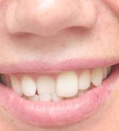 Tooth Implant