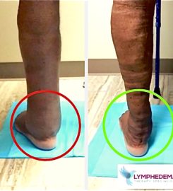 Lymphedema Therapy Specialists