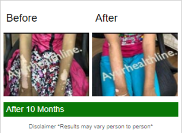 Ayurhealthline- Vitiligo Specialist Clinic