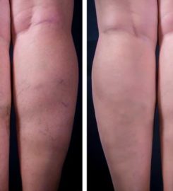 Vanish Advanced Vein Treatments