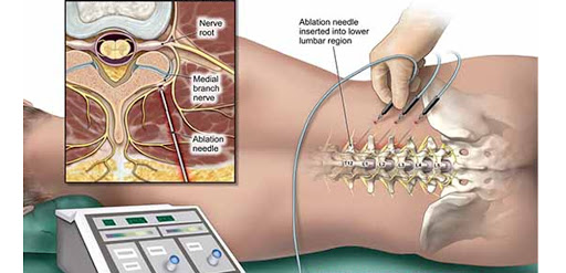 Achilles Tendon Pain
