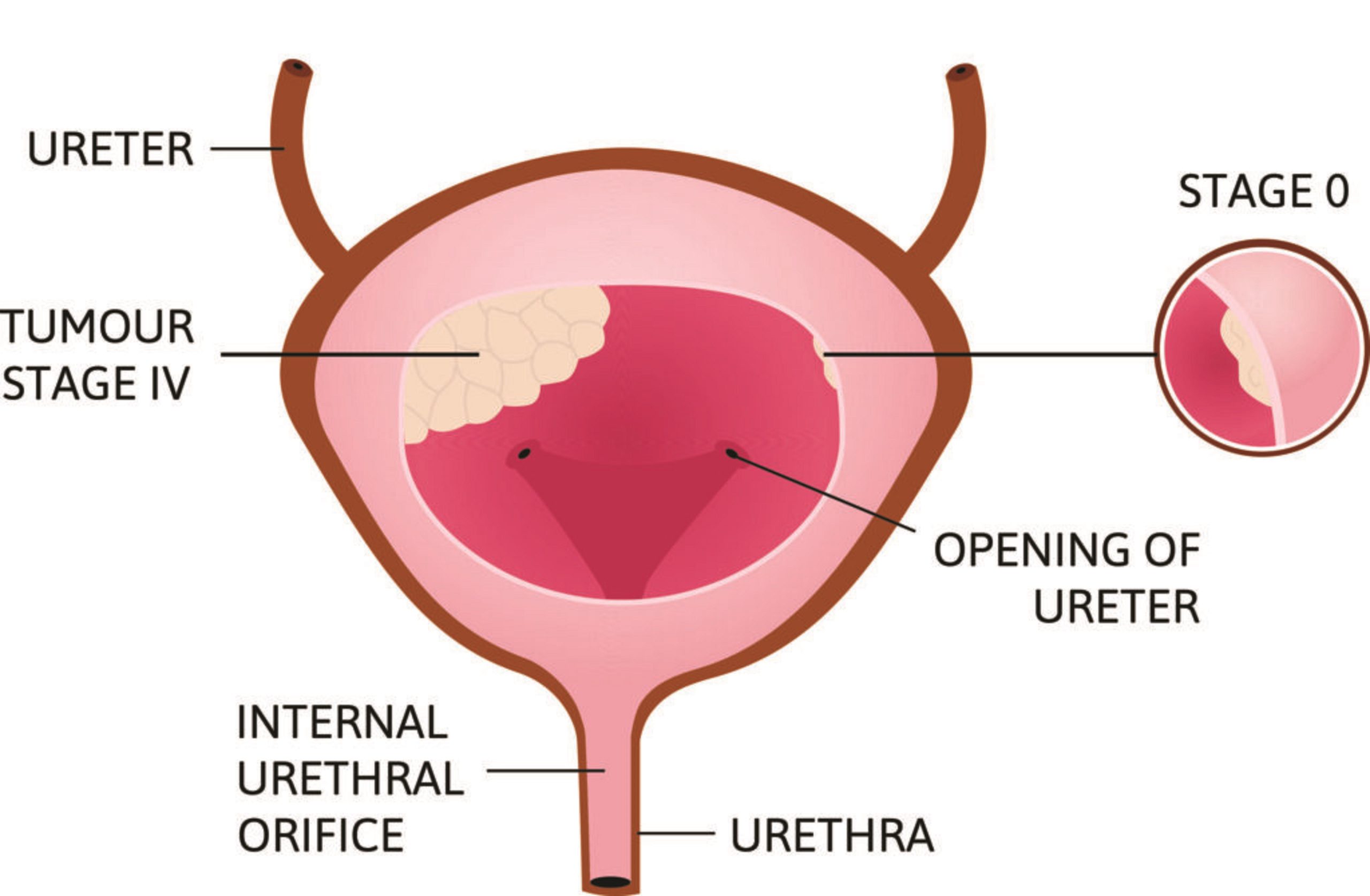 TURP Procedure Brooklyn