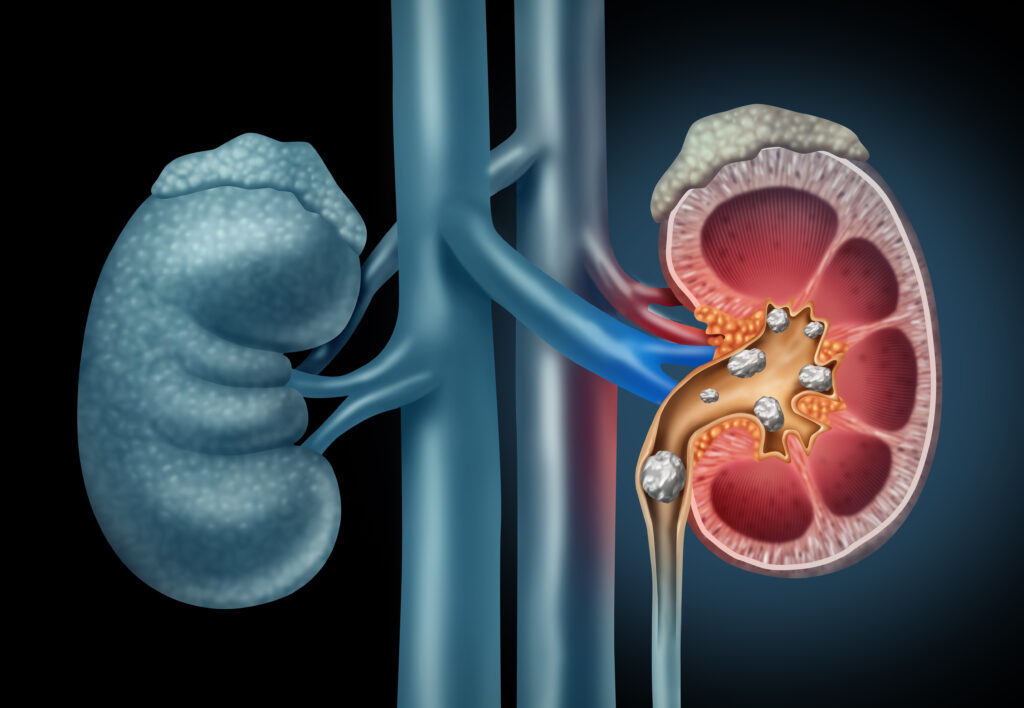 Kidney Stone Treatments