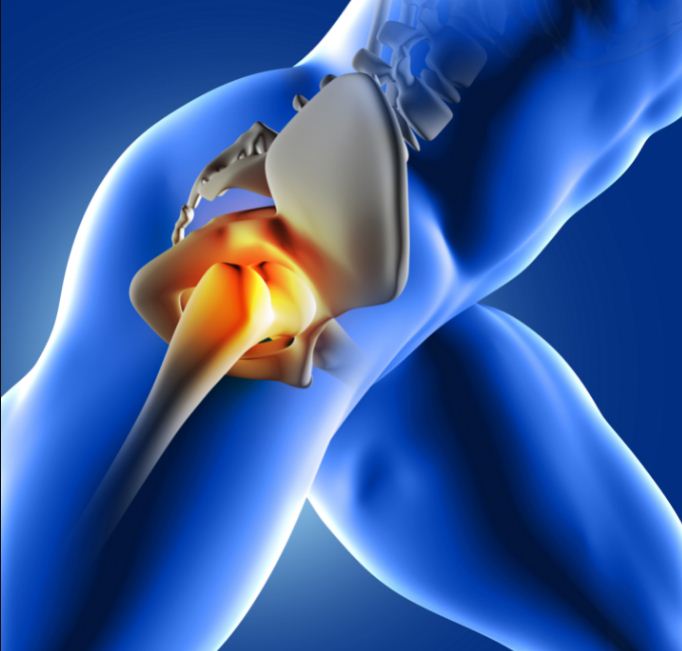 Why is hip replacement surgery done? | Specialty Care Clinics