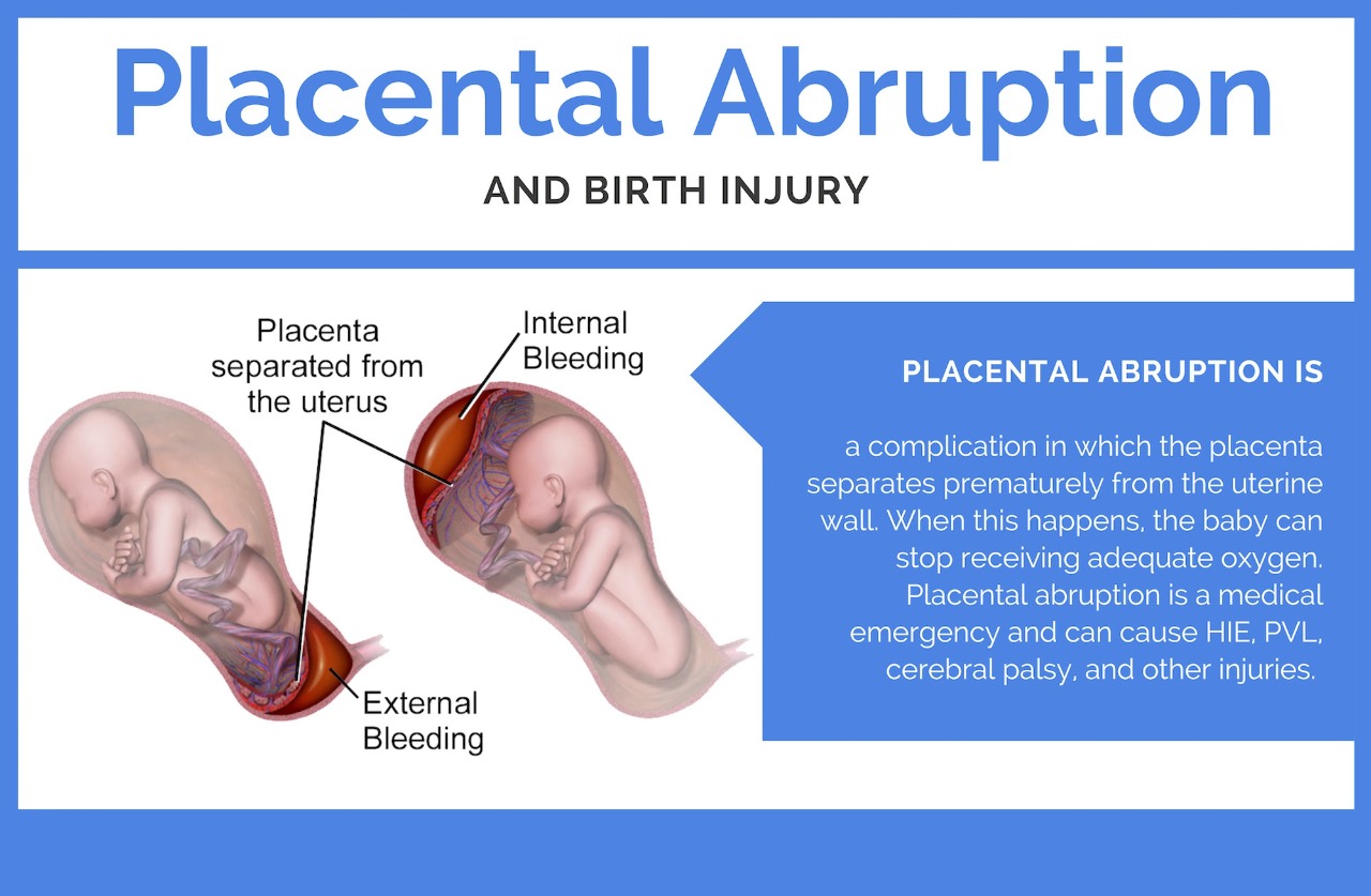 What is Placental Abruption? | Specialty Care Clinics