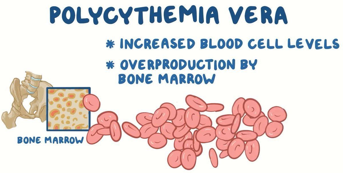 Polycythemia Vera Risk factors and Treatment