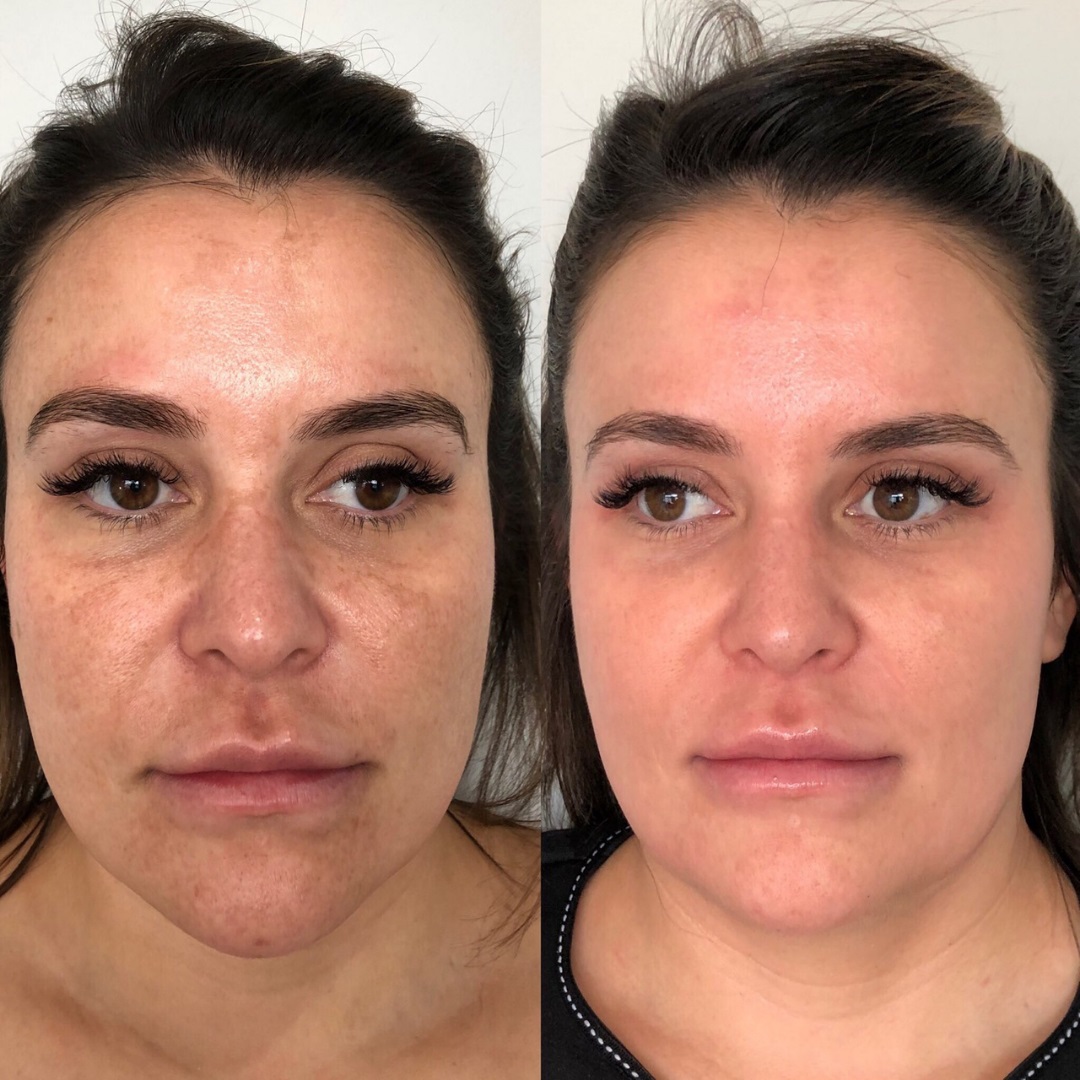 Skin Radiance – Mobile Cosmelan Specialist