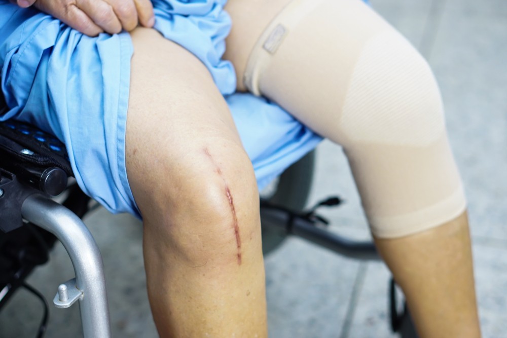 Knee Surgery in Dubai – Nanoori