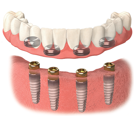 Dental Implant Aesthetic Center