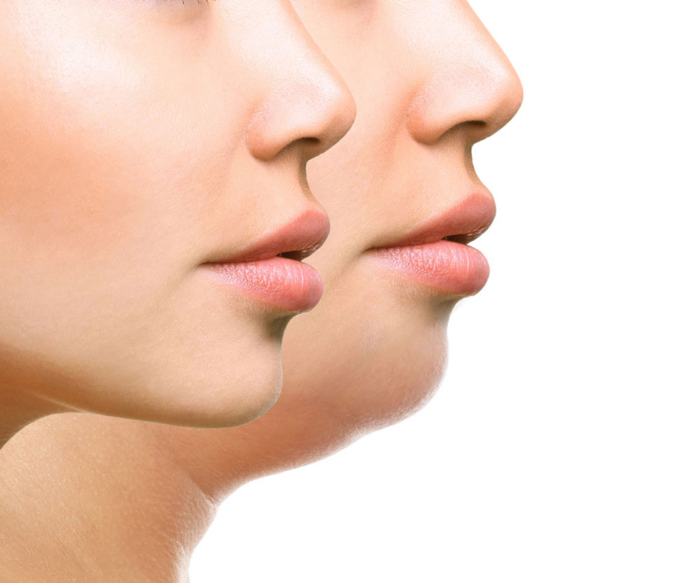 Double Chin Removal in Dubai