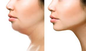 Kybella Treatment for Double Chin in Dubai